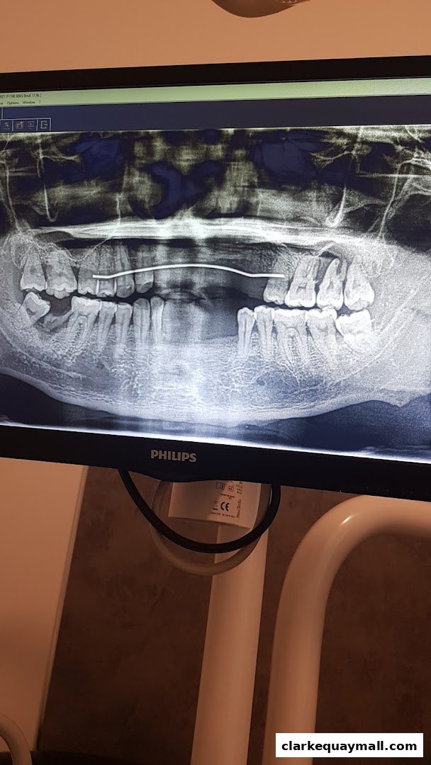 A dental X-ray of teeth with a wire brace is displayed on a computer monitor.